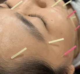 美顔針 / 減肥針